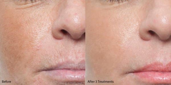 Collagen Induction Therapy