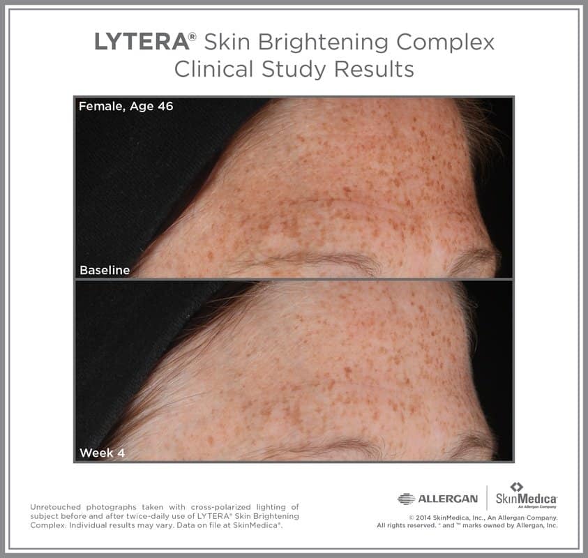Lytera Before and After Gallery