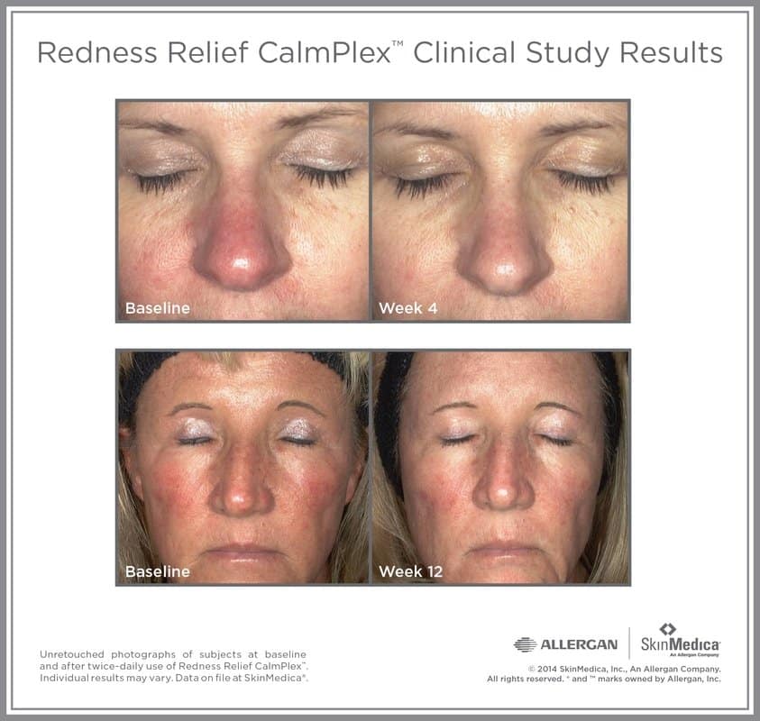 Redness Relief CalmPlex Before and After Gallery
