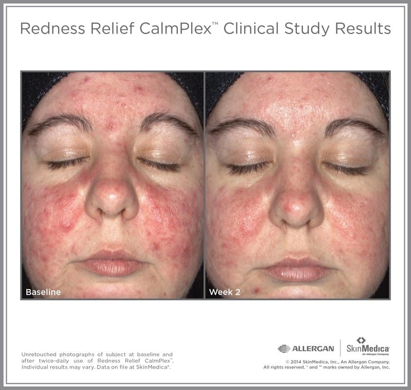 Redness Relief CalmPlex Before and After Gallery