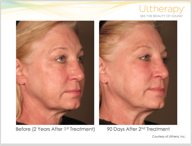 Non-Surgical Ultherapy Treatment