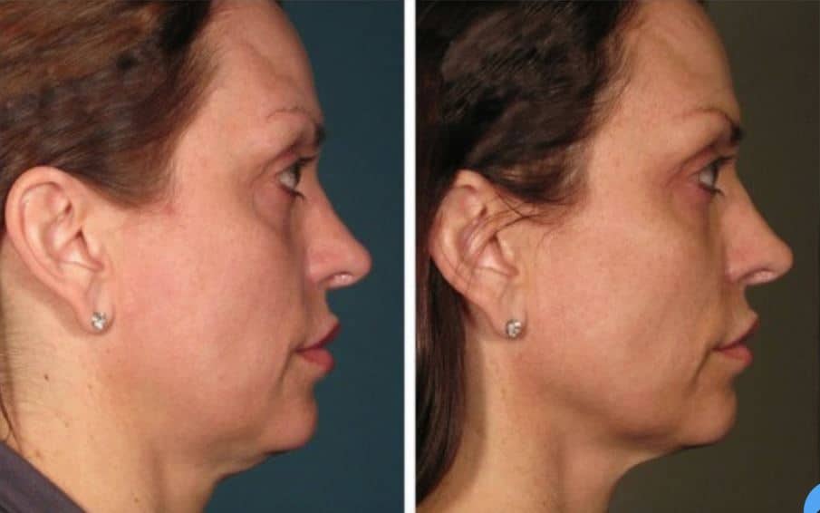 Non-Surgical Ultherapy Treatment